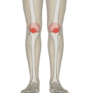 Patellofemoral pain syndrome (PFPS) is a pain behind or around your kneecap